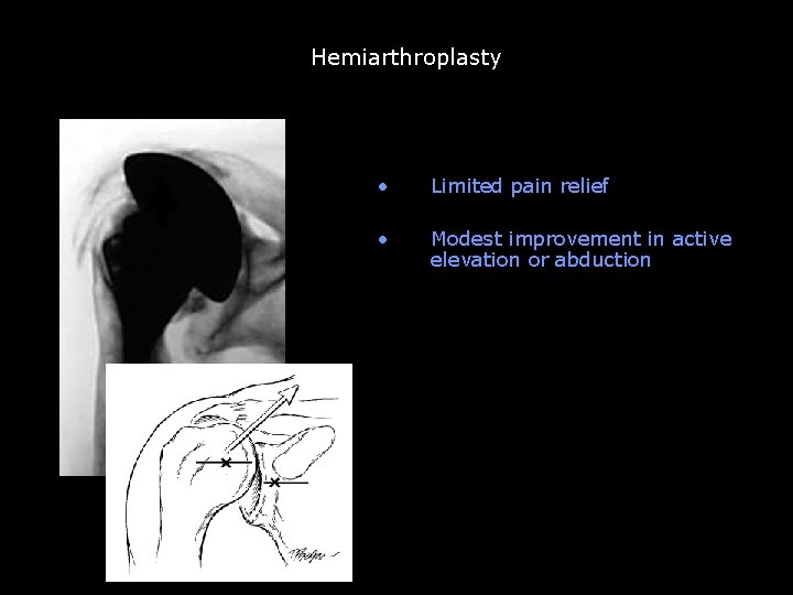 Hemiarthroplasty Unconstrained TSA abandoned b/c of glenoid loosening • Limited pain relief • Modest Hemiarthroplasty Unconstrained TSA abandoned b/c of glenoid loosening • Limited pain relief • Modest