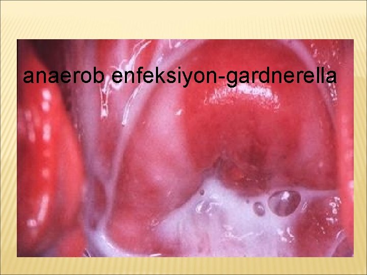 anaerob enfeksiyon-gardnerella 