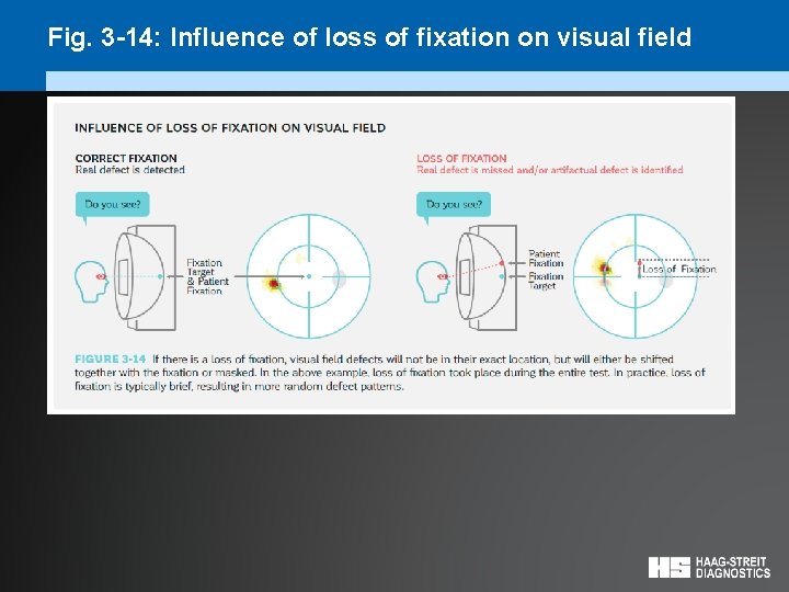Fig. 3 -14: Influence of loss of fixation on visual field 