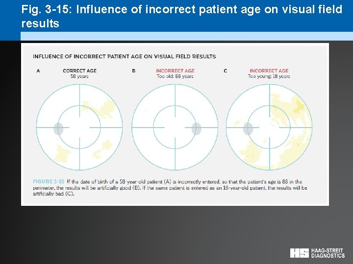 Fig. 3 -15: Influence of incorrect patient age on visual field results 