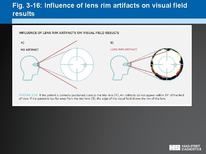 Fig. 3 -16: Influence of lens rim artifacts on visual field results 