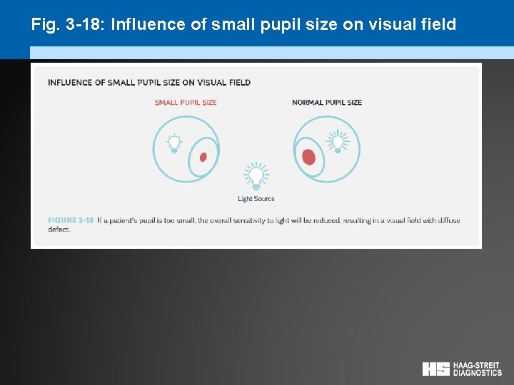 Fig. 3 -18: Influence of small pupil size on visual field 