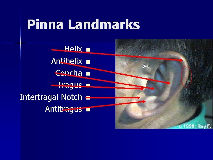 Pinna Landmarks Helix Antihelix Concha Tragus Intertragal Notch Antitragus n n n 