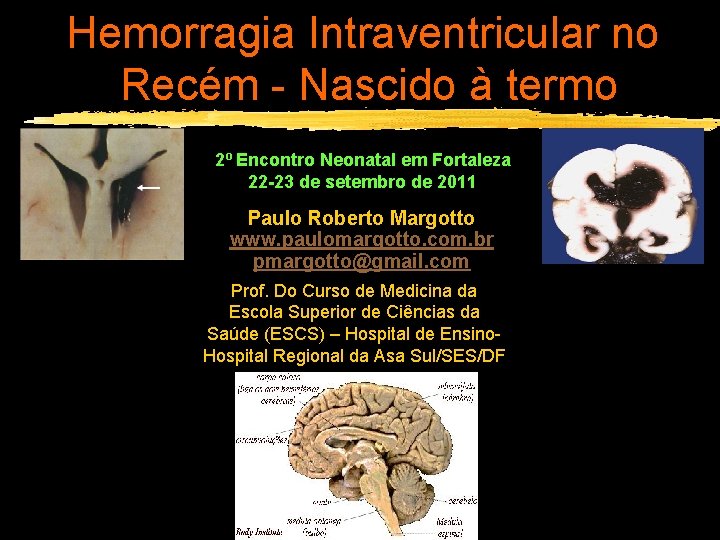 Hemorragia Intraventricular no Recém - Nascido à termo 2º Encontro Neonatal em Fortaleza 22