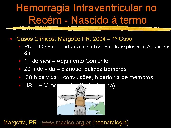 Hemorragia Intraventricular no Recém - Nascido à termo • Casos Clínicos: Margotto PR, 2004