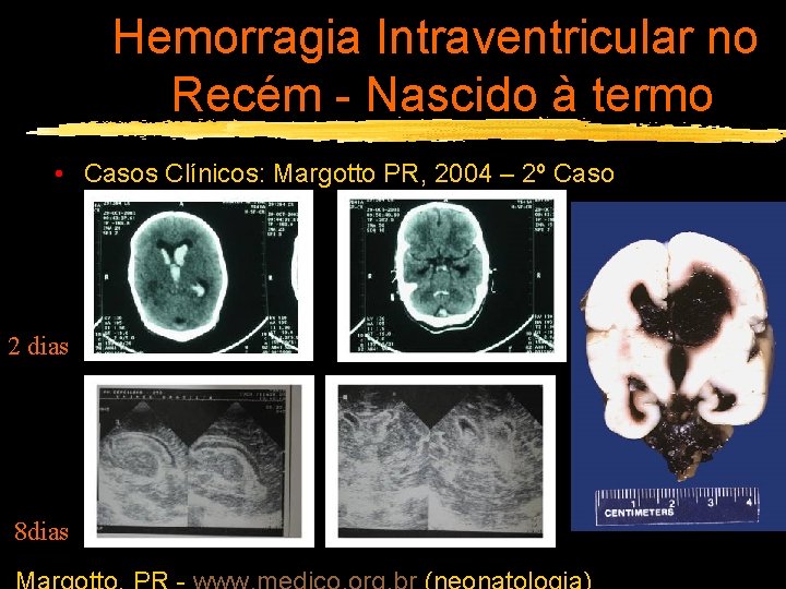 Hemorragia Intraventricular no Recém - Nascido à termo • Casos Clínicos: Margotto PR, 2004
