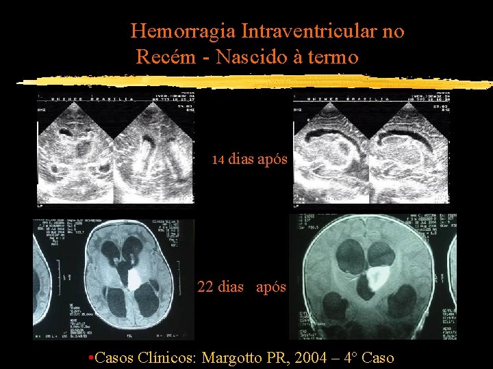 Hemorragia Intraventricular no Recém - Nascido à termo 14 dias após 22 dias após