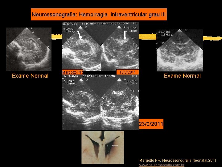 Neurossonografia: Hemorragia intraventricular grau III Exame Normal Margotto PR 18/2/2011 Exame Normal 23/2/2011 Margotto