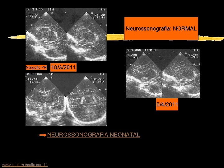 Neurossonografia: NORMAL 10/3/2011 Margotto PR 5/4/2011 Clicar aqui! NEUROSSONOGRAFIA NEONATAL Paulo R. Margotto (consulte