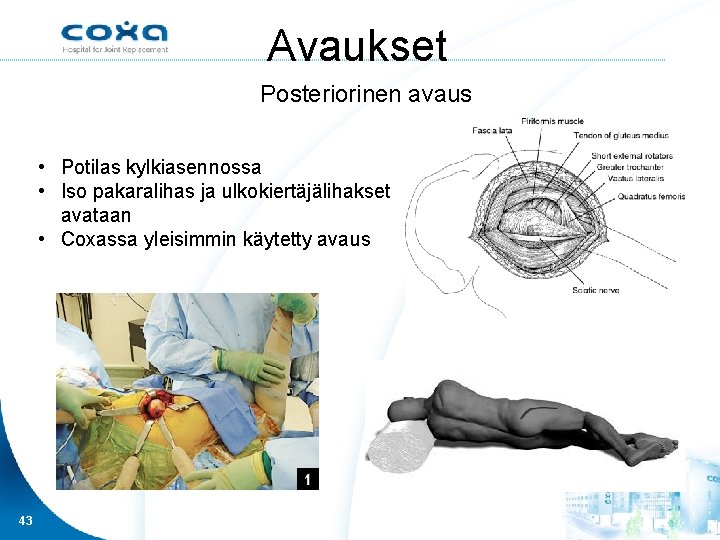 Avaukset Posteriorinen avaus • Potilas kylkiasennossa • Iso pakaralihas ja ulkokiertäjälihakset avataan • Coxassa