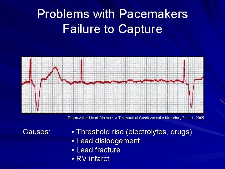 Problems with Pacemakers Failure to Capture Braunwald's Heart Disease: A Textbook of Cardiovascular Medicine,