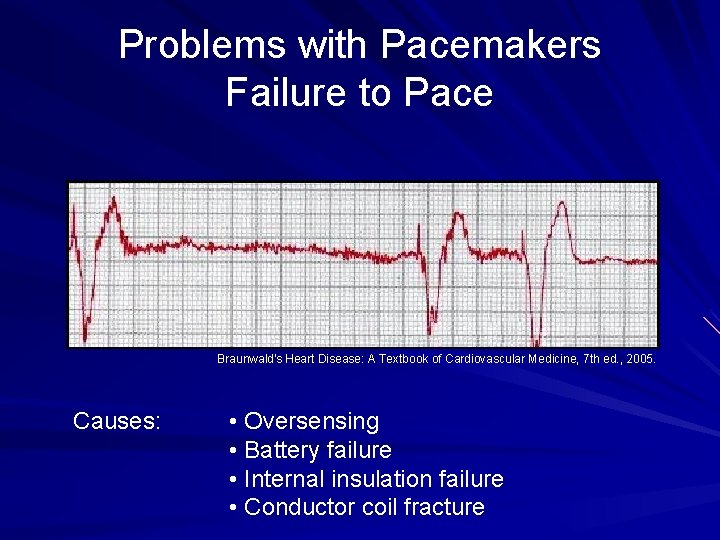 Problems with Pacemakers Failure to Pace Braunwald's Heart Disease: A Textbook of Cardiovascular Medicine,