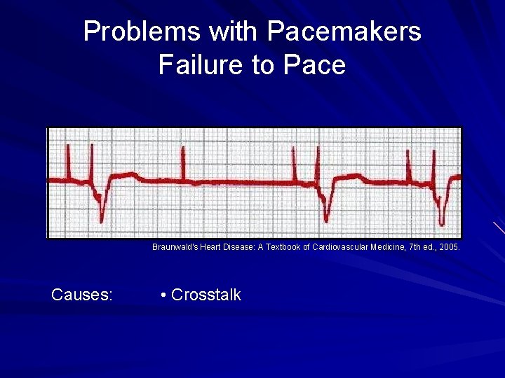 Problems with Pacemakers Failure to Pace Braunwald's Heart Disease: A Textbook of Cardiovascular Medicine,