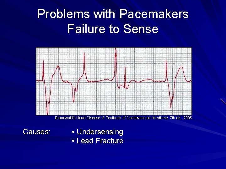 Problems with Pacemakers Failure to Sense Braunwald's Heart Disease: A Textbook of Cardiovascular Medicine,