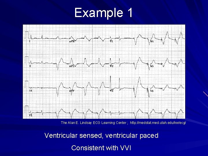 Example 1 The Alan E. Lindsay ECG Learning Center ; http: //medstat. med. utah.