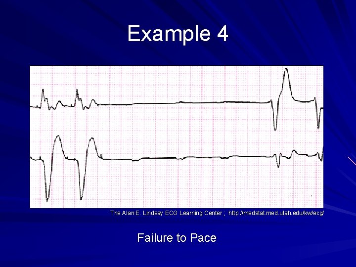 Example 4 The Alan E. Lindsay ECG Learning Center ; http: //medstat. med. utah.