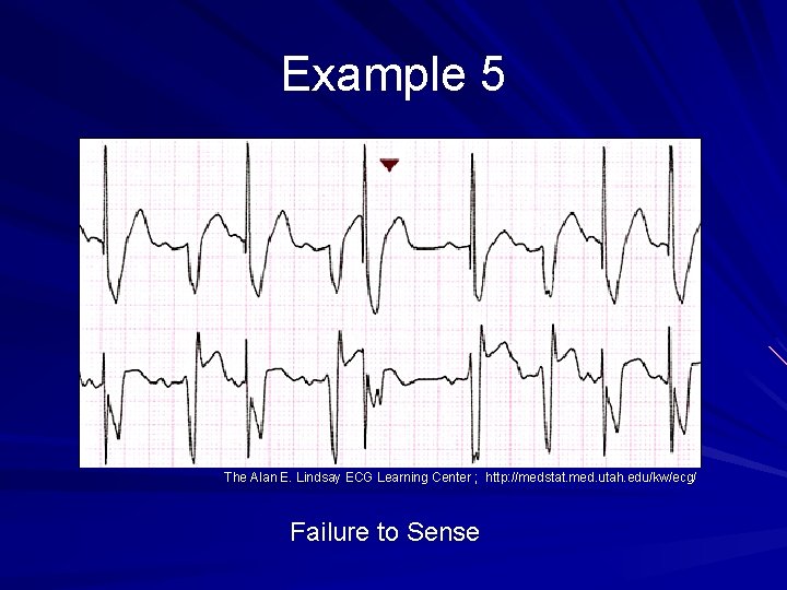 Example 5 The Alan E. Lindsay ECG Learning Center ; http: //medstat. med. utah.