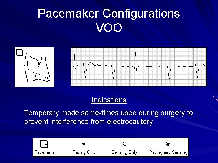 Pacemaker Configurations VOO Indications Temporary mode some-times used during surgery to prevent interference from