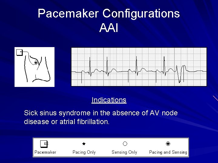 Pacemaker Configurations AAI Indications Sick sinus syndrome in the absence of AV node disease