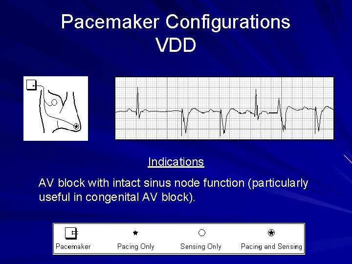 Pacemaker Configurations VDD Indications AV block with intact sinus node function (particularly useful in