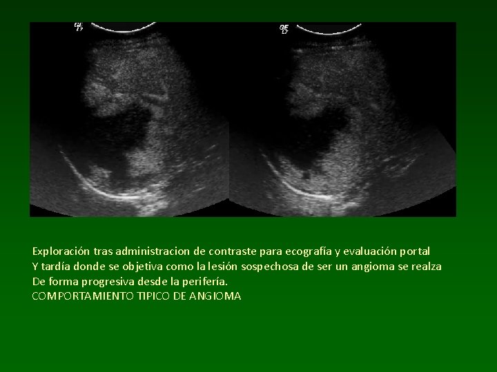 Exploración tras administracion de contraste para ecografía y evaluación portal Y tardía donde se