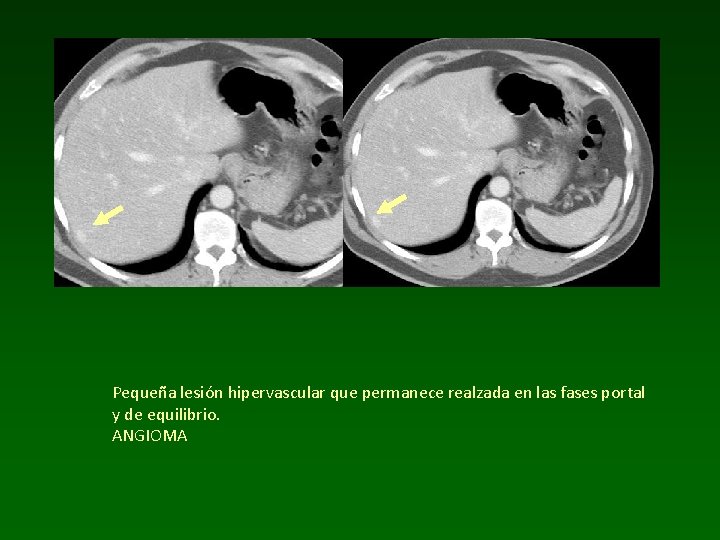 Pequeña lesión hipervascular que permanece realzada en las fases portal y de equilibrio. ANGIOMA