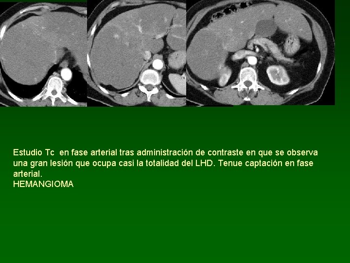 Estudio Tc en fase arterial tras administración de contraste en que se observa una