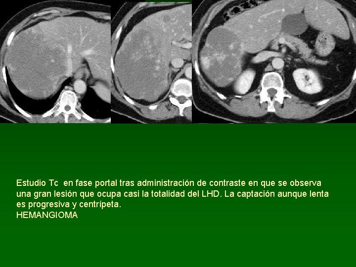 Estudio Tc en fase portal tras administración de contraste en que se observa una