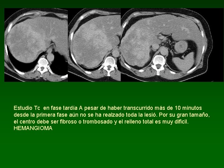 Estudio Tc en fase tardía A pesar de haber transcurrido más de 10 minutos