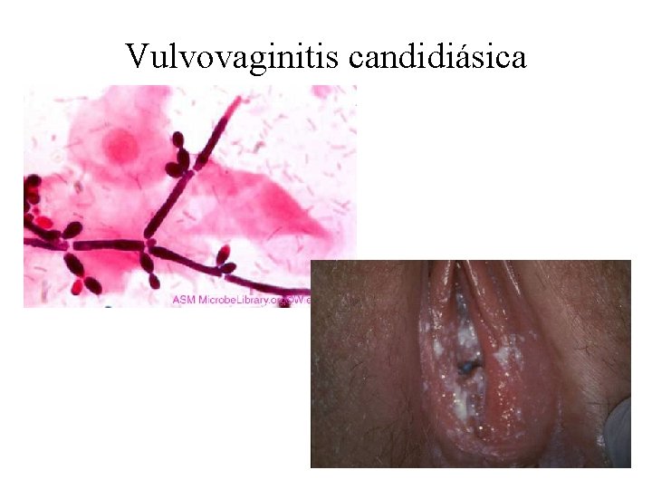 Vulvovaginitis candidiásica 