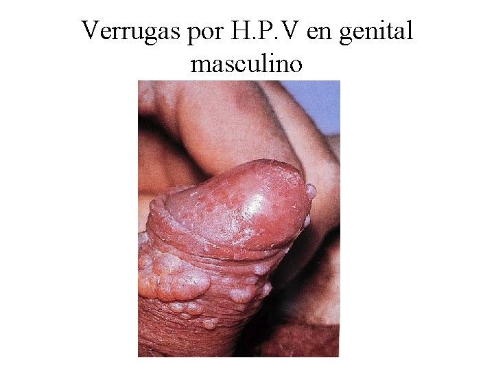 Verrugas por H. P. V en genital masculino 