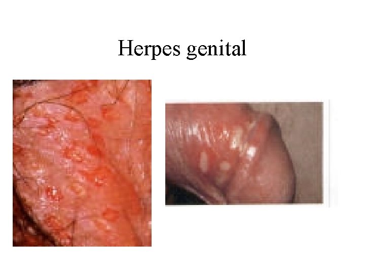 Herpes genital 