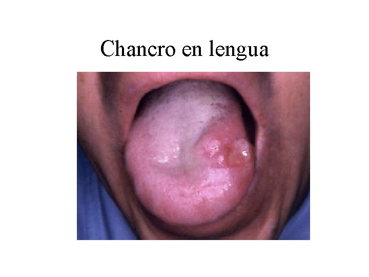 Chancro en lengua 
