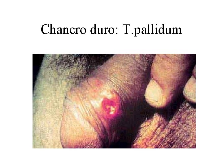 Chancro duro: T. pallidum 