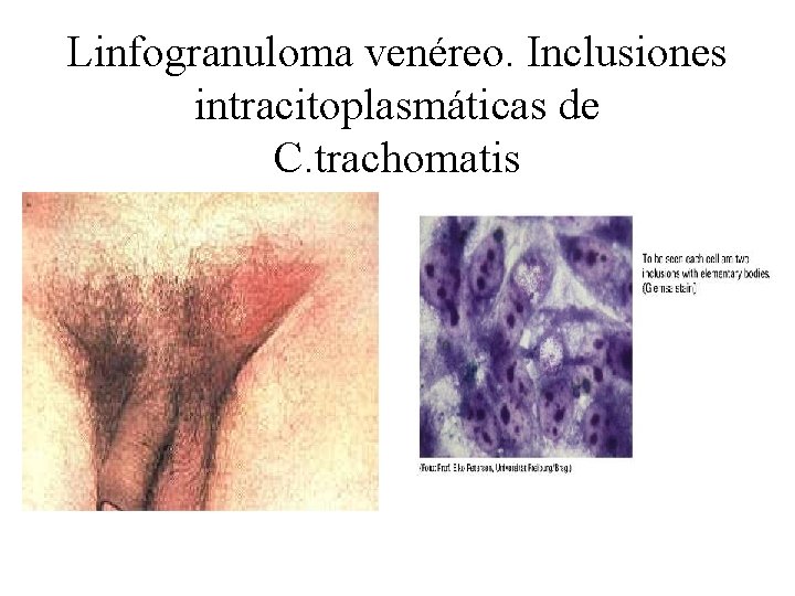 Linfogranuloma venéreo. Inclusiones intracitoplasmáticas de C. trachomatis 