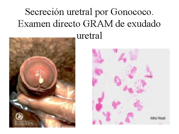 Secreción uretral por Gonococo. Examen directo GRAM de exudado uretral 