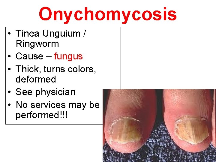 Onychomycosis • Tinea Unguium / Ringworm • Cause – fungus • Thick, turns colors,