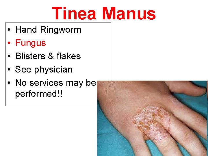 Tinea Manus • • • Hand Ringworm Fungus Blisters & flakes See physician No