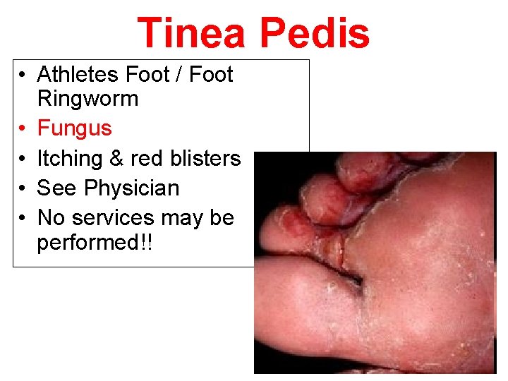 Tinea Pedis • Athletes Foot / Foot Ringworm • Fungus • Itching & red