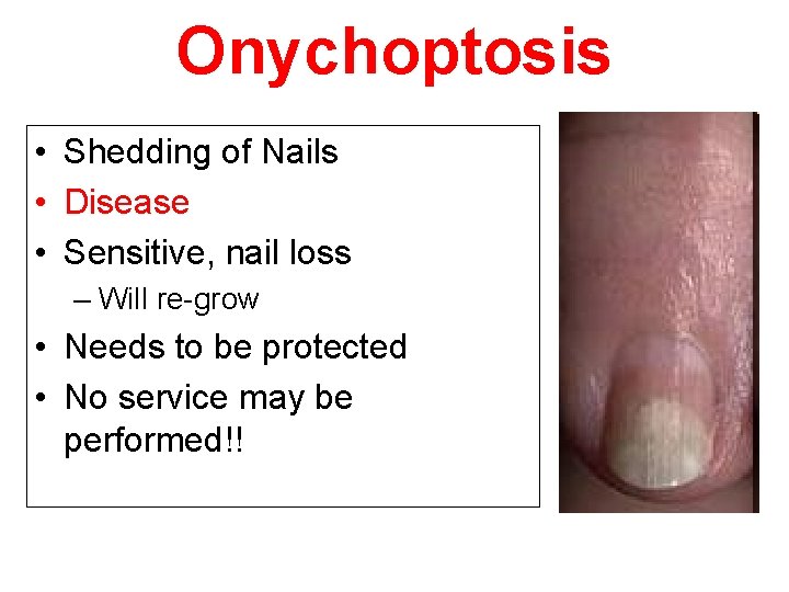 Onychoptosis • Shedding of Nails • Disease • Sensitive, nail loss – Will re-grow