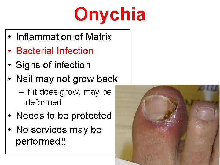 Onychia • • Inflammation of Matrix Bacterial Infection Signs of infection Nail may not