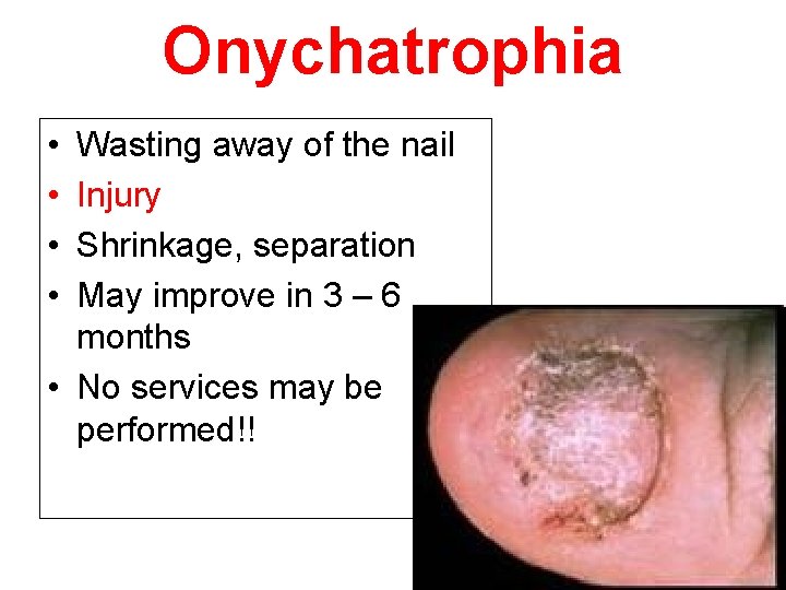 Onychatrophia • • Wasting away of the nail Injury Shrinkage, separation May improve in