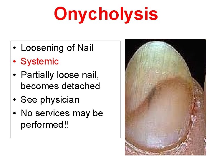 Onycholysis • Loosening of Nail • Systemic • Partially loose nail, becomes detached •