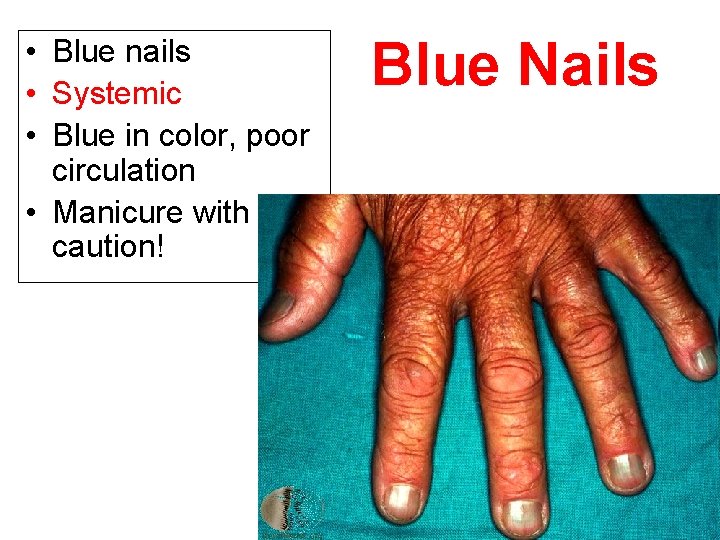  • Blue nails • Systemic • Blue in color, poor circulation • Manicure