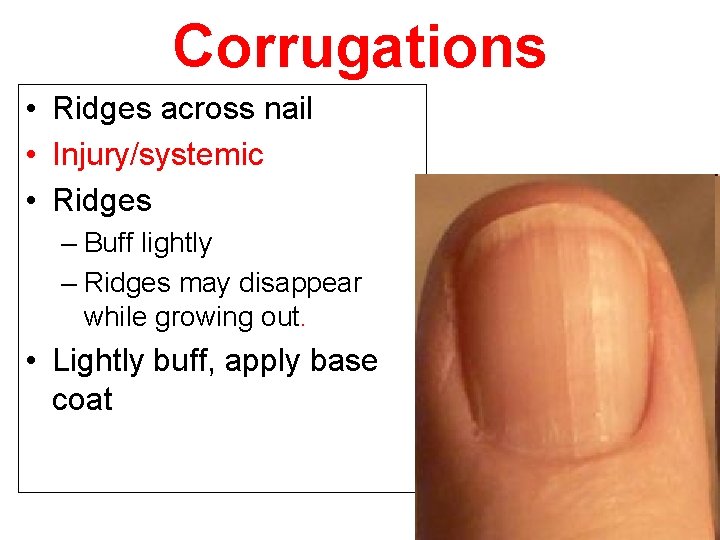 Corrugations • Ridges across nail • Injury/systemic • Ridges – Buff lightly – Ridges
