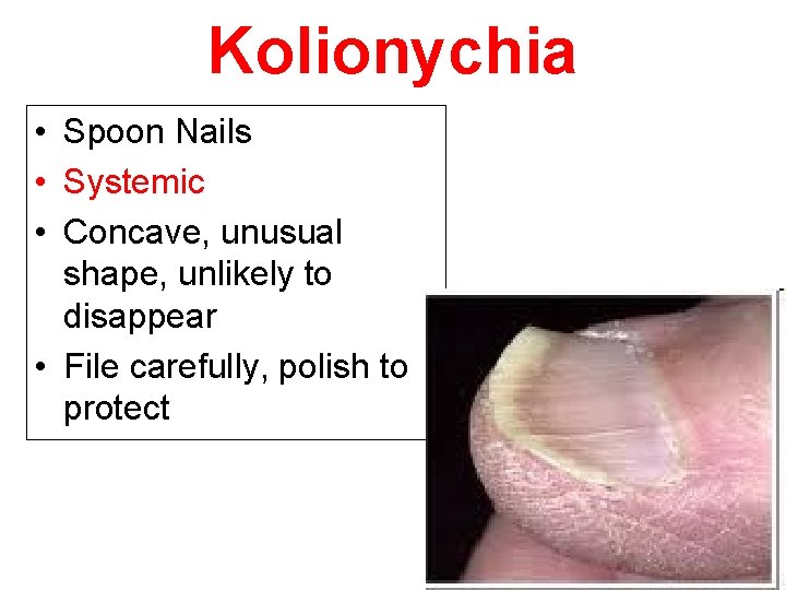 Kolionychia • Spoon Nails • Systemic • Concave, unusual shape, unlikely to disappear •