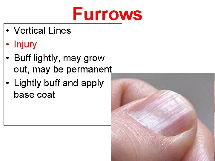 Furrows • Vertical Lines • Injury • Buff lightly, may grow out, may be