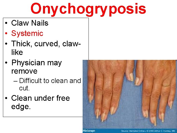 Onychogryposis • Claw Nails • Systemic • Thick, curved, clawlike • Physician may remove