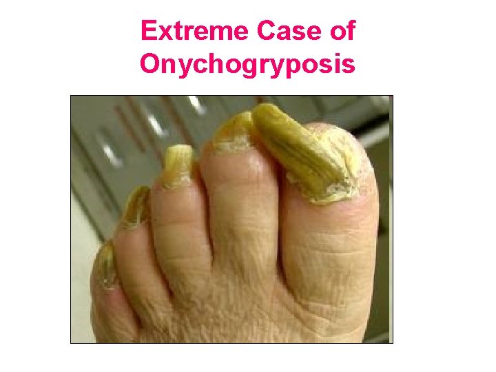 Extreme Case of Onychogryposis 