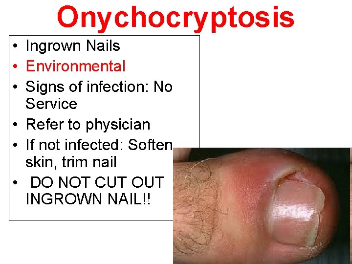 Onychocryptosis • Ingrown Nails • Environmental • Signs of infection: No Service • Refer